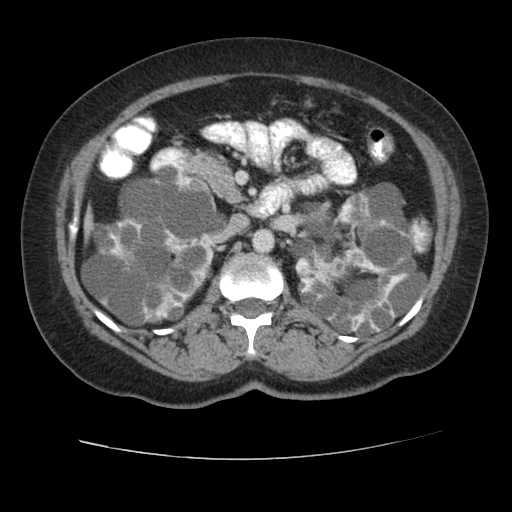 Autosomal dominant polycystic kidney disease with hepatic involvement (Radiopaedia 32693-33662 B 32).jpg