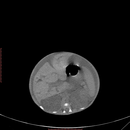 Autosomal recessive polycystic kidney disease associated with Caroli disease (Radiopaedia 61932-69984 Axial non-contrast 168).jpg