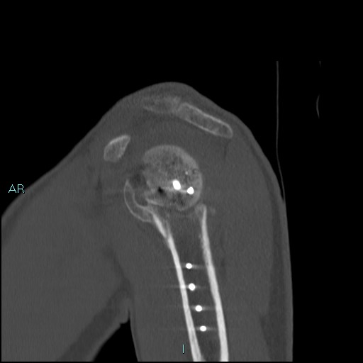 File:Avascular necrosis after fracture dislocations of the proximal humerus (Radiopaedia 88078-104653 Sagittal bone window 27).jpg