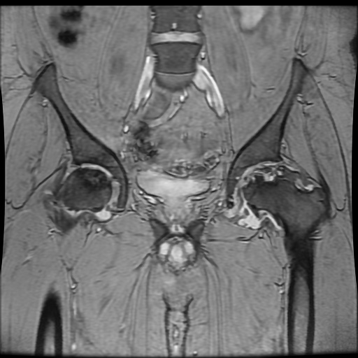 Avascular necrosis of the hip (Radiopaedia 61503-69465 F 39).jpg
