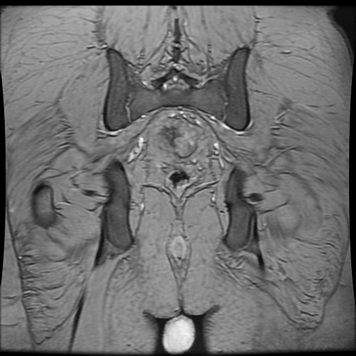 Avascular necrosis of the hip (Radiopaedia 61503-69465 F 84).jpg