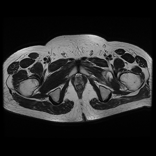 File:Avascular necrosis of the hip (Radiopaedia 61503-69465 T2 23).jpg