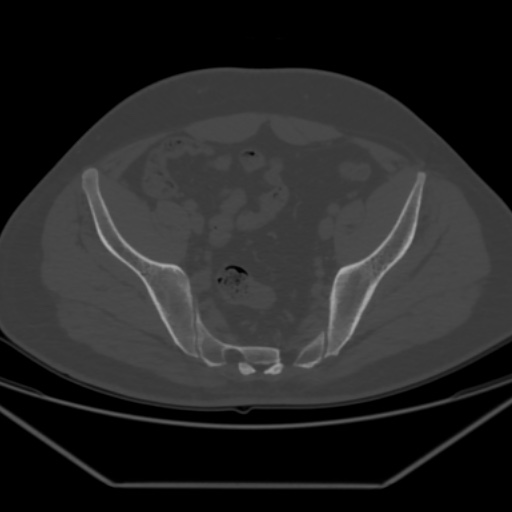 File:Avascular necrosis of the hip (Radiopaedia 61503-69467 Axial bone window 17).jpg