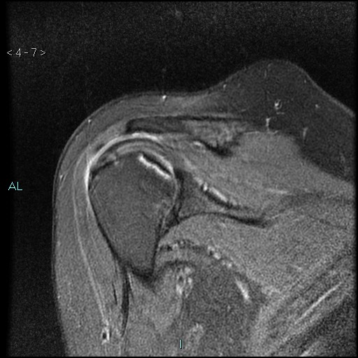 File:Avascular necrosis of the shoulder - Cruess stage I (Radiopaedia 77674-89886 Coronal PD fat sat 7).jpg