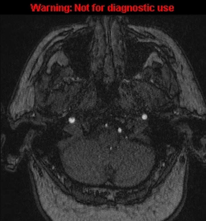 Azygos anterior cerebral artery (Radiopaedia 59325-66677 Axial MRA 13).jpg