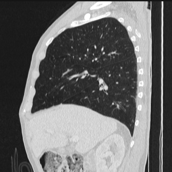 Azygos lobe (Radiopaedia 38259-40275 lung window 34).jpg