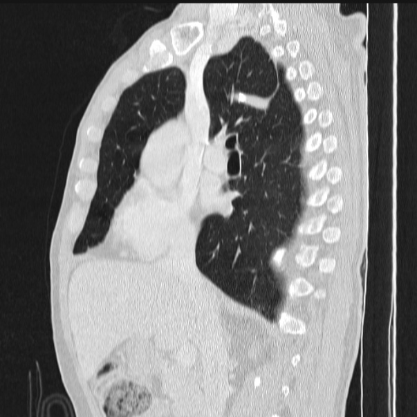 Azygos lobe (Radiopaedia 38259-40275 lung window 44).jpg