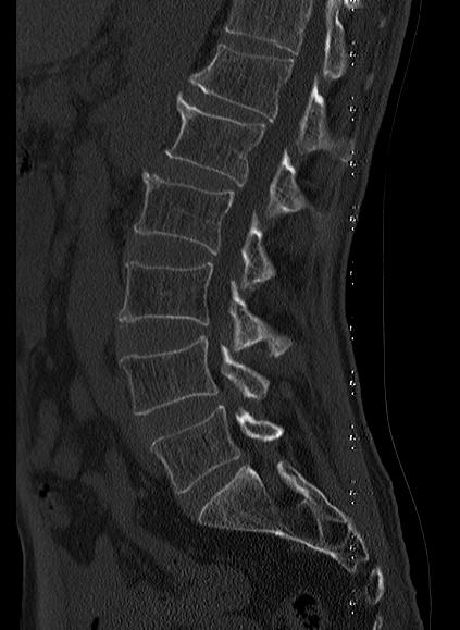 File:Baastrup syndrome (Radiopaedia 64891-73838 Sagittal bone window 13).jpg
