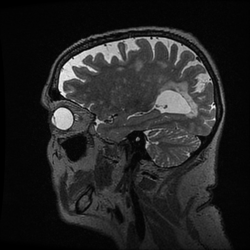 Balo concentric sclerosis (Radiopaedia 53875-59982 Sagittal 3D FSE 86).jpg