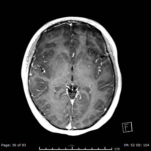 Balo concentric sclerosis (Radiopaedia 61637-69636 Axial T1 C+ 36).jpg