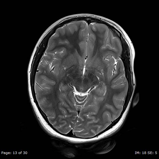 File:Balo concentric sclerosis (Radiopaedia 61637-69636 Axial T2 13).jpg
