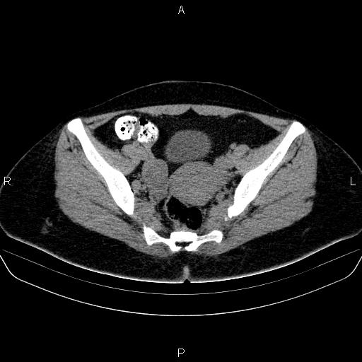 Bartholin gland cyst (Radiopaedia 62635-70930 Axial non-contrast 39).jpg