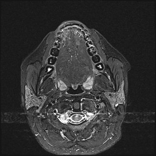 File:Basal cell carcinoma - nasal region (Radiopaedia 70292-80365 Axial STIR 23).jpg