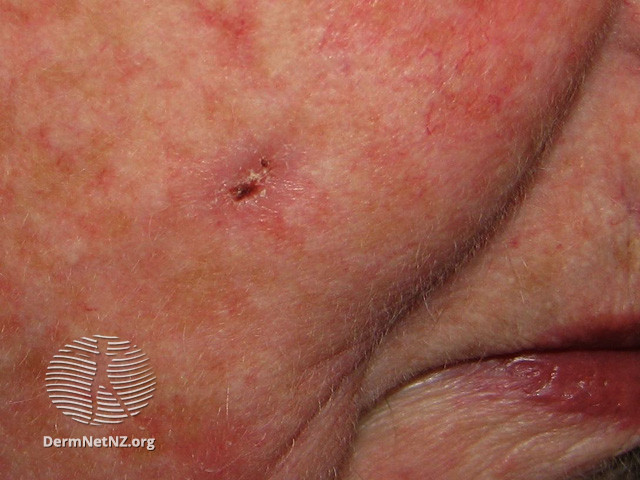 Basal cell carcinoma affecting the face (DermNet NZ lesions-bcc-face-0683).jpg