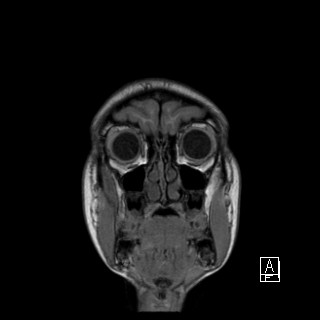 Base of skull rhabdomyosarcoma (Radiopaedia 32196-33142 Coronal T1 2).jpg