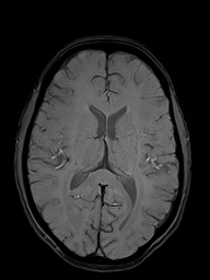 Basilar artery perforator aneurysm (Radiopaedia 82455-97733 Axial SWI 33).jpg