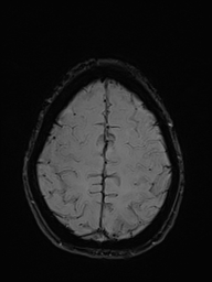 Basilar artery perforator aneurysm (Radiopaedia 82455-97733 Axial SWI 50).jpg
