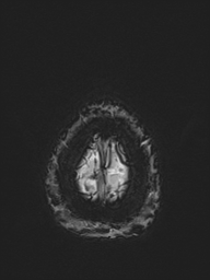 Basilar artery perforator aneurysm (Radiopaedia 82455-97733 Axial SWI 61).jpg