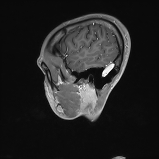 Basilar artery perforator aneurysm (Radiopaedia 82455-97733 G 23).jpg