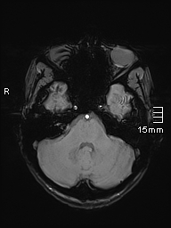 Basilar artery perforator aneurysm (Radiopaedia 82455-99523 Axial SWI 16).jpg