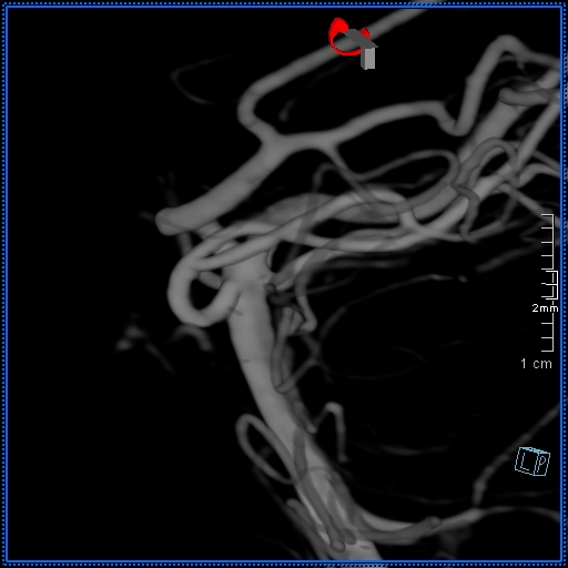 Basilar artery perforator aneurysm (Radiopaedia 82455-99524 3D Left VA 13).jpg