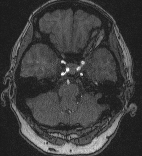 File:Basilar tip aneurysm (Radiopaedia 26504-26632 MRA 48).jpg