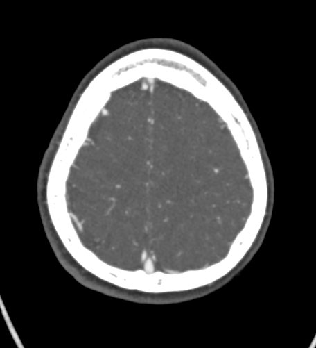 Basilar tip aneurysm with coiling (Radiopaedia 53912-60086 A 124).jpg
