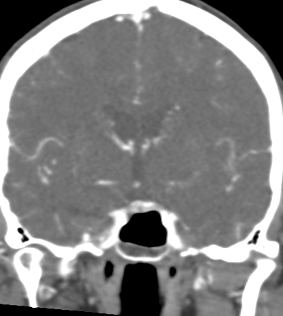 Basilar tip aneurysm with coiling (Radiopaedia 53912-60086 B 69).jpg