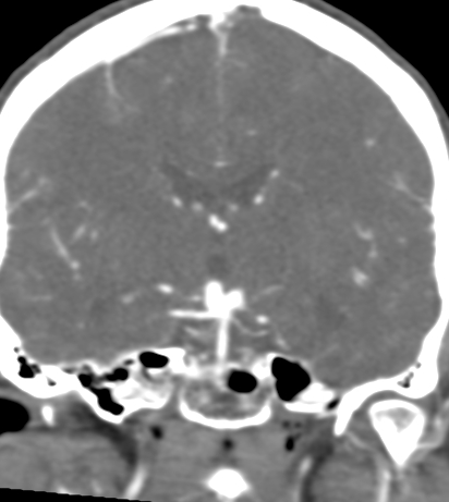 Basilar tip aneurysm with coiling (Radiopaedia 53912-60086 B 76).jpg