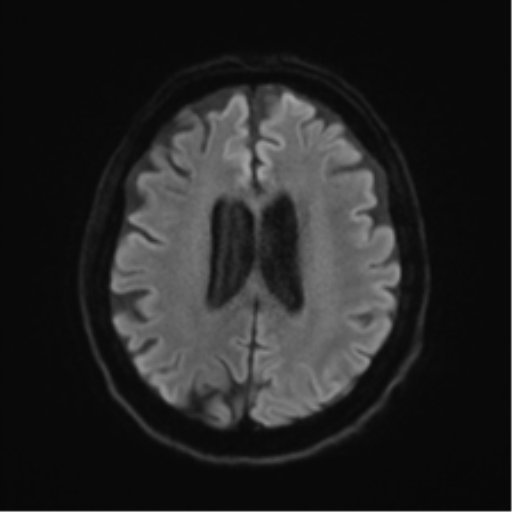 Behavioral variant frontotemporal dementia and late onset schizophrenia (Radiopaedia 52197-58083 Axial DTI Trace W 44).png