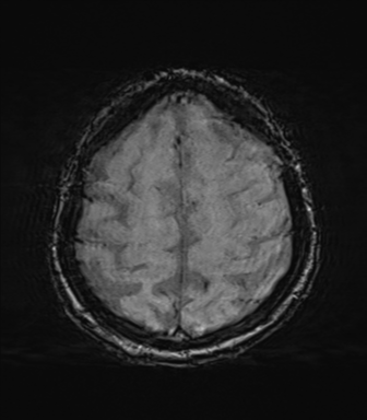 File:Behavioral variant frontotemporal dementia and late onset schizophrenia (Radiopaedia 52197-58083 Axial SWI 61).png