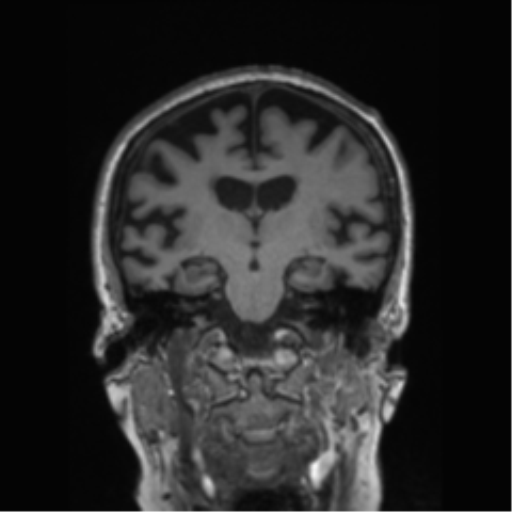 Behavioral variant frontotemporal dementia and late onset schizophrenia (Radiopaedia 52197-58083 Coronal T1 48).png