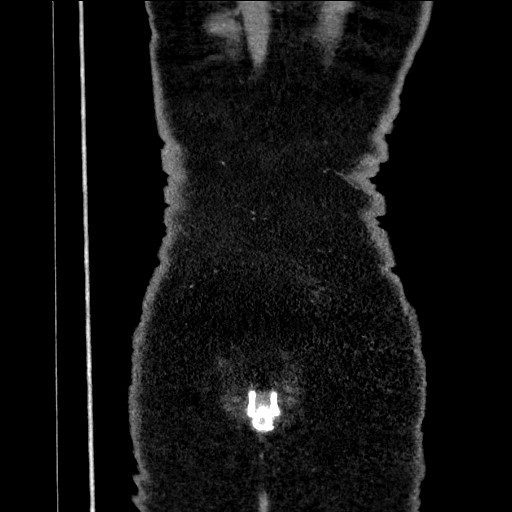 Benign leiomyoma with hydropic features (Radiopaedia 89250-106130 B 107).jpg