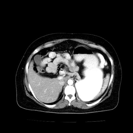 Benign spindle cell tumor - abdominopelvic (Radiopaedia 61300-69212 A 15).jpg