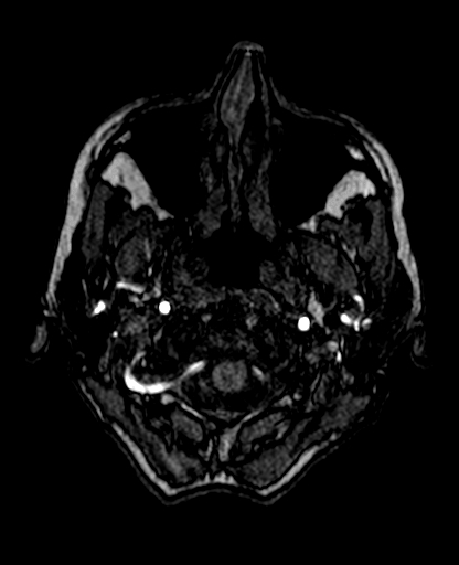 Berry aneurysm of the terminal internal carotid artery (Radiopaedia 88286-104918 Axial TOF 37).jpg