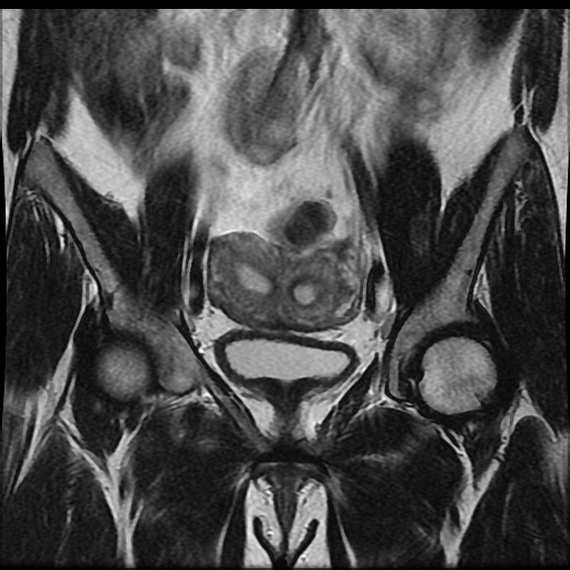 File:Bicornuate uterus (Radiopaedia 51676-57472 Coronal T2 11).jpg