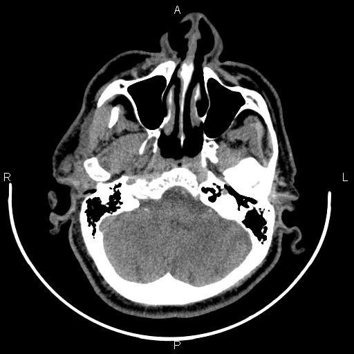 Bilateral Warthin tumors (Radiopaedia 84034-99263 Axial non-contrast 7).jpg