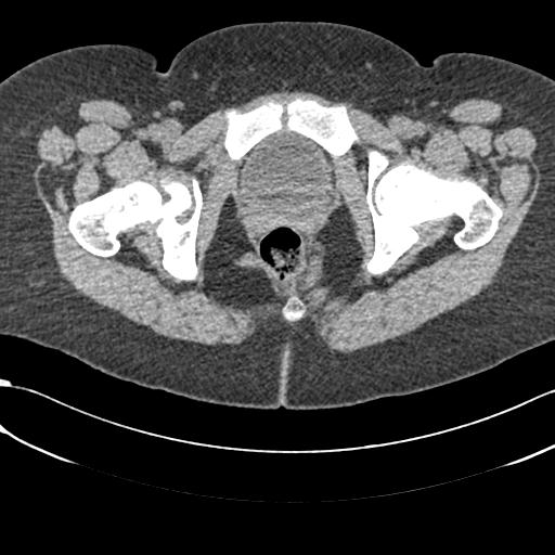 File:Bilateral acetabular protrusion with pincer type femoro-acetabular impingement (Radiopaedia 30134-30733 AXIAL SOFT THIN 63).jpg