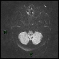 File:Bilateral acute middle cerebral artery territory infarcts (Radiopaedia 77319-89402 Axial DWI 29).jpg