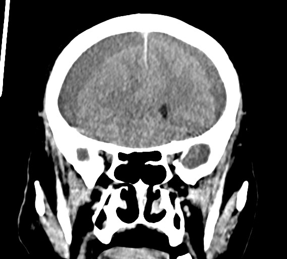 Bilateral acute on chronic subdural hematomas (Radiopaedia 78466-91146 Coronal non-contrast 24).jpg