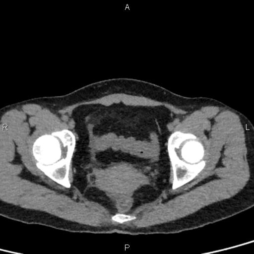Bilateral adrenal gland hyperenhancement in pancreatitis (Radiopaedia 86642-102753 Axial non-contrast 102).jpg
