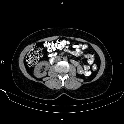 Bilateral adrenal myelolipoma (Radiopaedia 63058-71535 Axial non-contrast 88).jpg