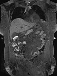 Bilateral adrenal myelolipoma (Radiopaedia 63058-71537 Coronal T1 fat sat 75).jpg