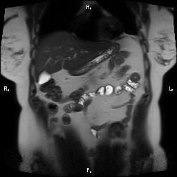File:Bilateral adrenal myelolipoma (Radiopaedia 63058-71537 Coronal T2 25).jpg