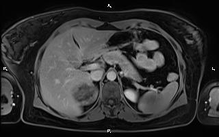 File:Bilateral adrenal myelolipoma (Radiopaedia 63058-71537 H 31).jpg