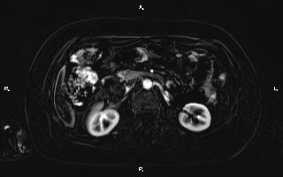 Bilateral adrenal myelolipoma (Radiopaedia 63058-71537 I 48).jpg