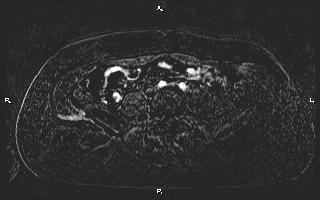 Bilateral adrenal myelolipoma (Radiopaedia 63058-71537 I 78).jpg