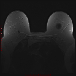 File:Bilateral breast implant rupture (Radiopaedia 24761-25027 PASTA 6).jpg