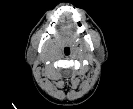 Bilateral carotid body tumors (Radiopaedia 61841-69870 Axial non-contrast 27).jpg