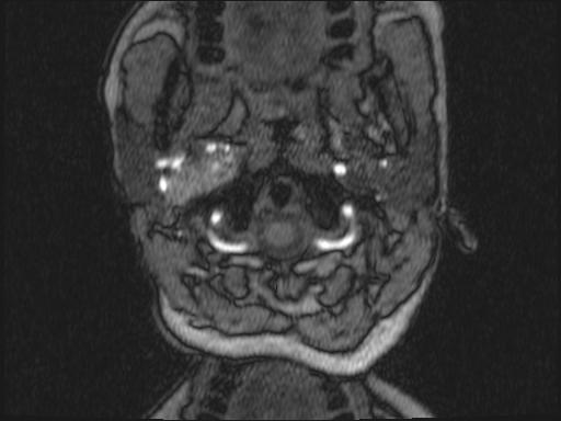 Bilateral carotid body tumors and right glomus jugulare tumor (Radiopaedia 20024-20060 Axial MRA 289).jpg